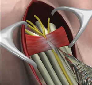 Carpal Tunnel Release Surgery