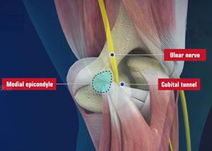 Cubital Tunnel Syndrome (Ulnar Nerve Entrapment)