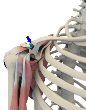 Distal Clavicle Excision