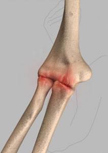 Elbow Arthritis