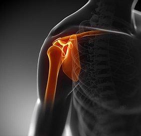 Shoulder Tendonitis