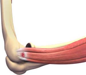 Tennis Elbow Surgery